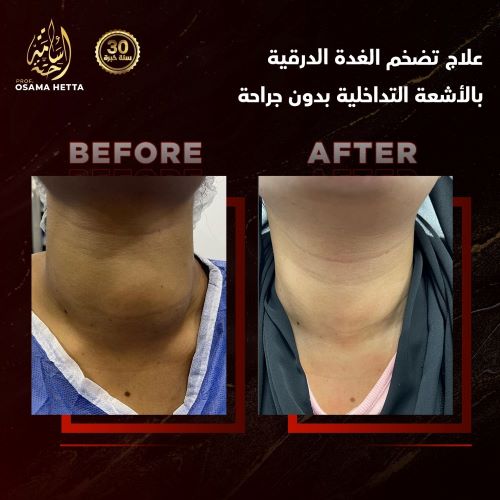 علاج الغدة الدرقية بالأشعة التداخلية